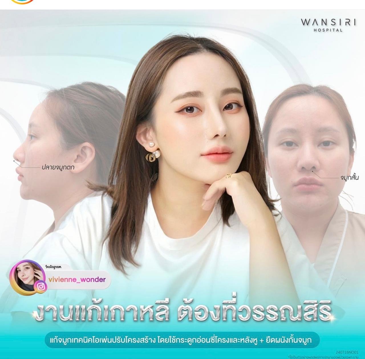 Before and after result by Dr. Jiraroch Meevassana