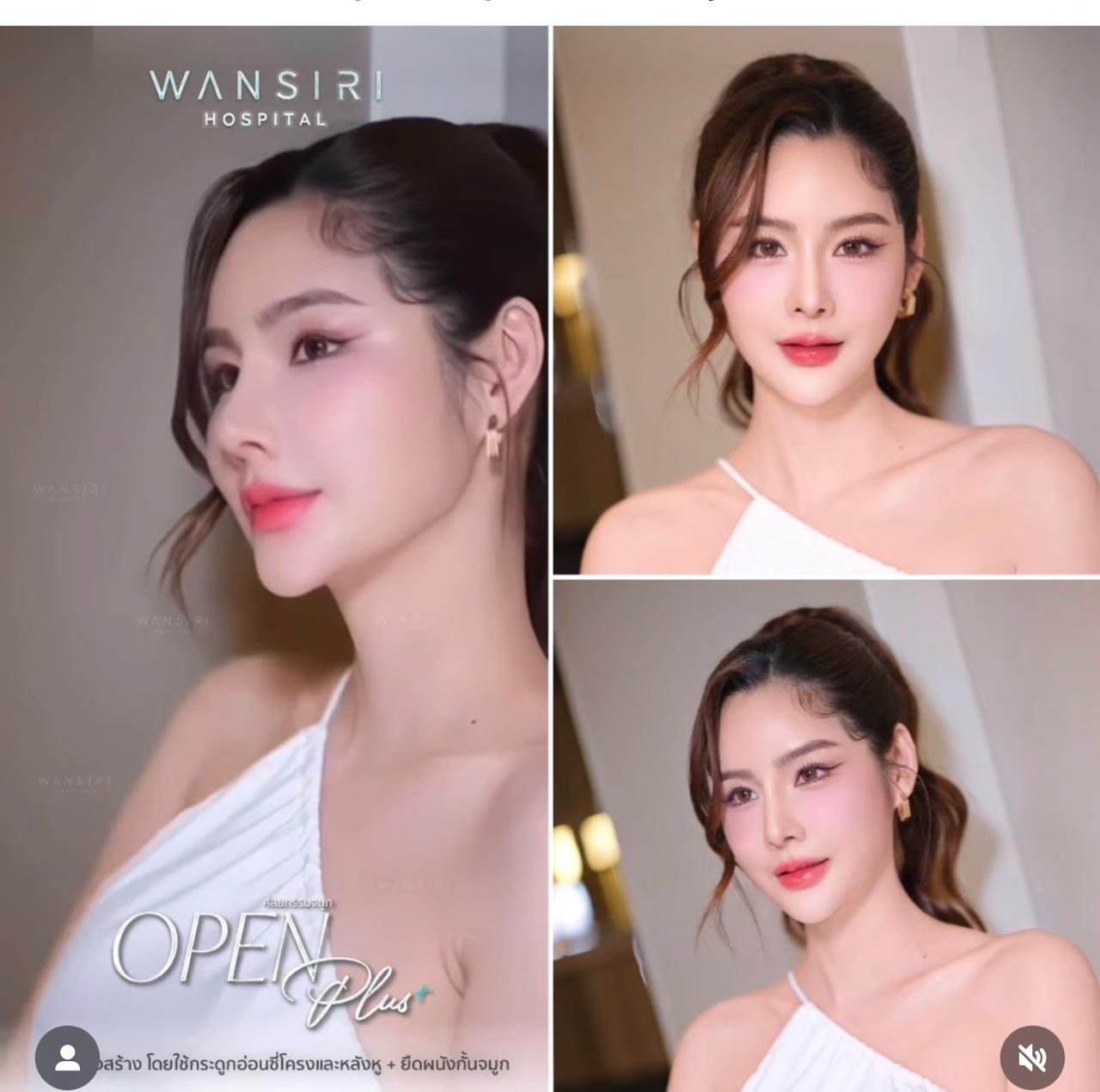 Before and after result by Dr. Jiraroch Meevassana