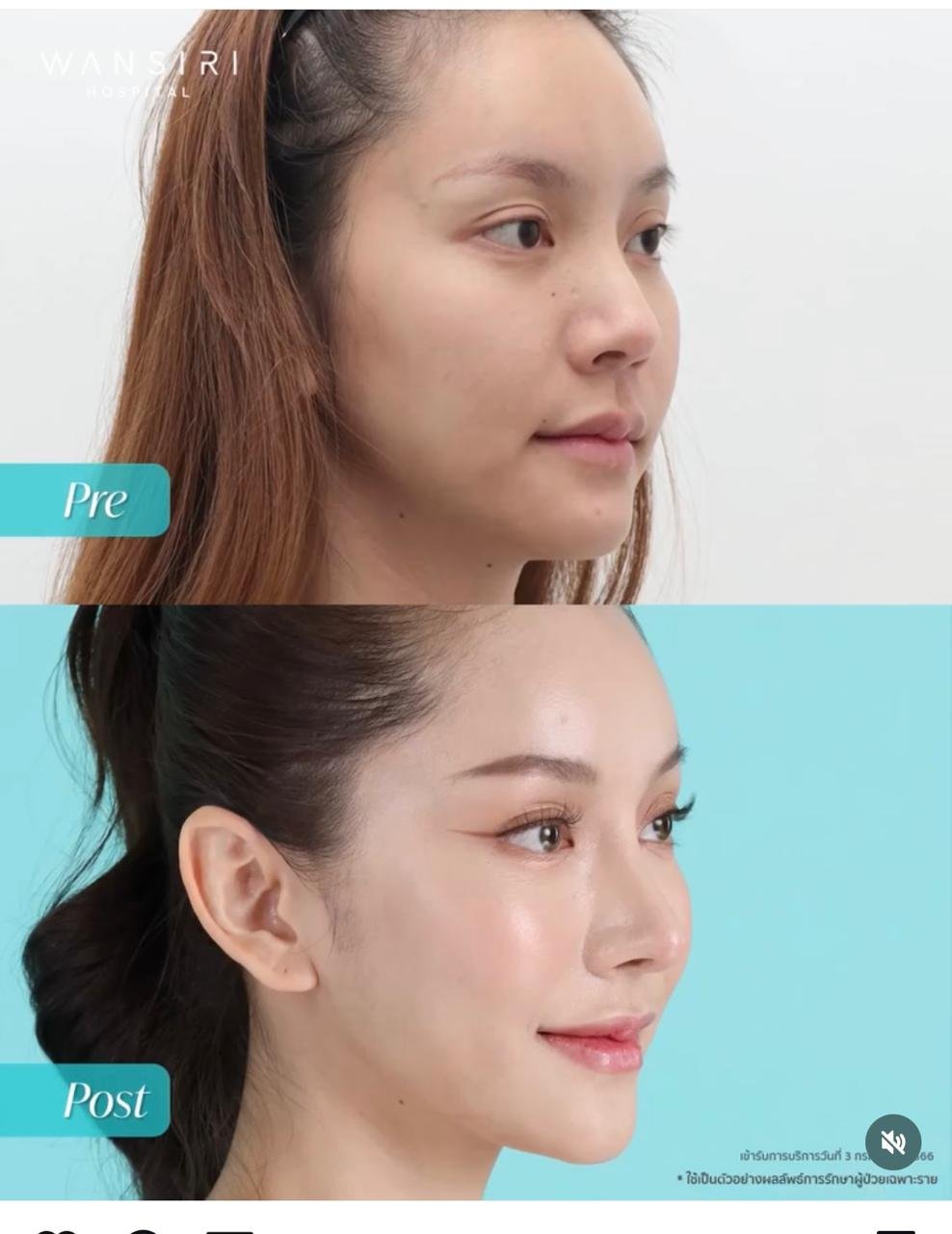 Before and after result by Dr. Jiraroch Meevassana