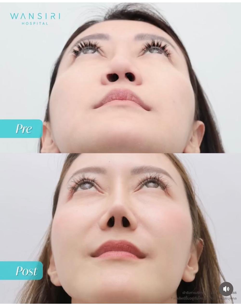 Before and after result by Dr. Jiraroch Meevassana