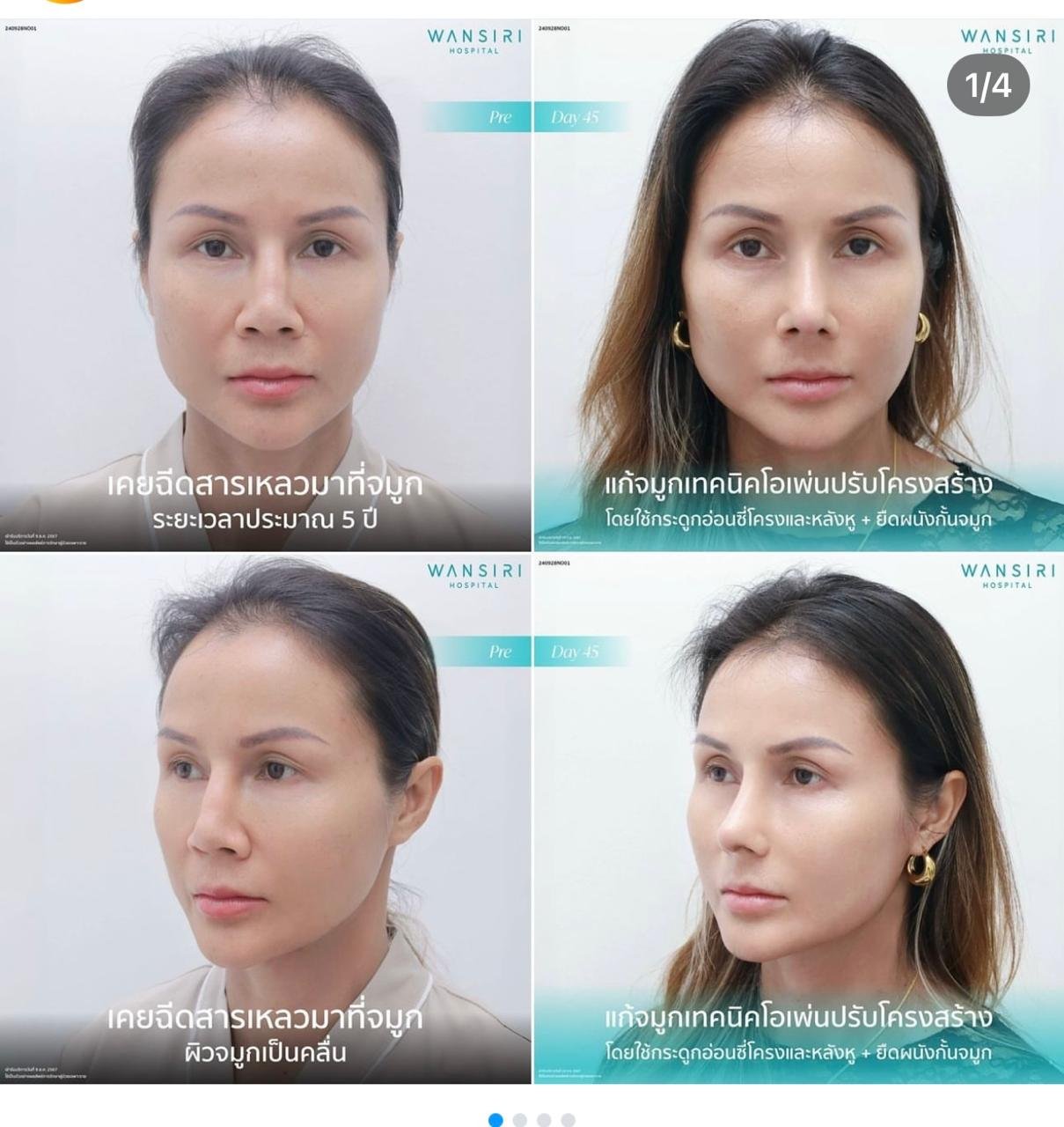 Before and after result by Dr. Jiraroch Meevassana