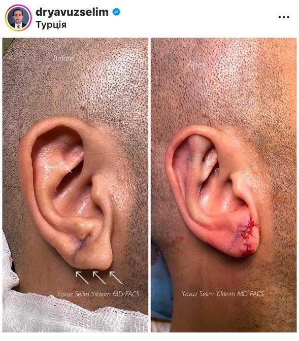 Before and after result by Dr. Yavuz Selim Yıldırım