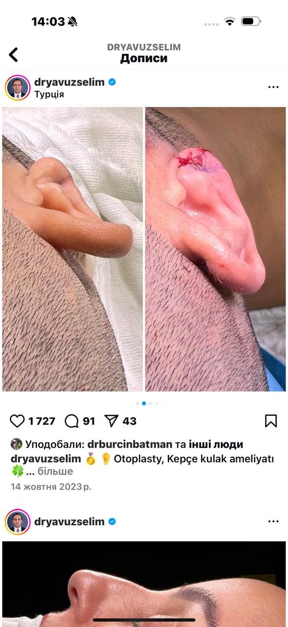 Before and after result by Dr. Yavuz Selim Yıldırım