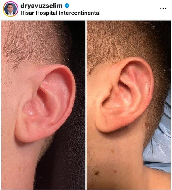 Before and after result by Dr. Yavuz Selim Yıldırım