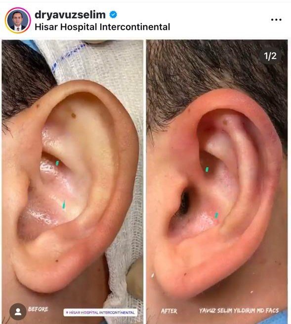 Before and after result by Dr. Yavuz Selim Yıldırım