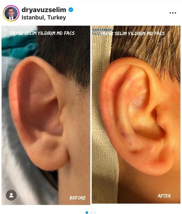 Before and after result by Dr. Yavuz Selim Yıldırım
