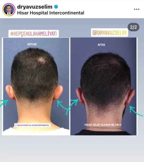 Before and after result by Dr. Yavuz Selim Yıldırım