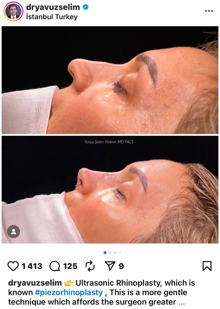 Before and after result by Dr. Yavuz Selim Yıldırım
