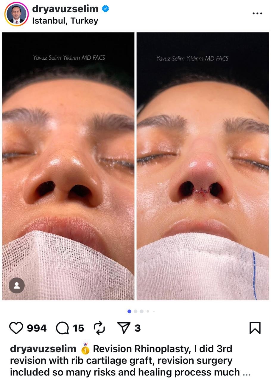 Before and after result by Dr. Yavuz Selim Yıldırım
