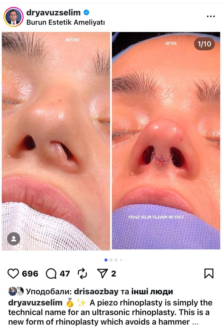 Before and after result by Dr. Yavuz Selim Yıldırım