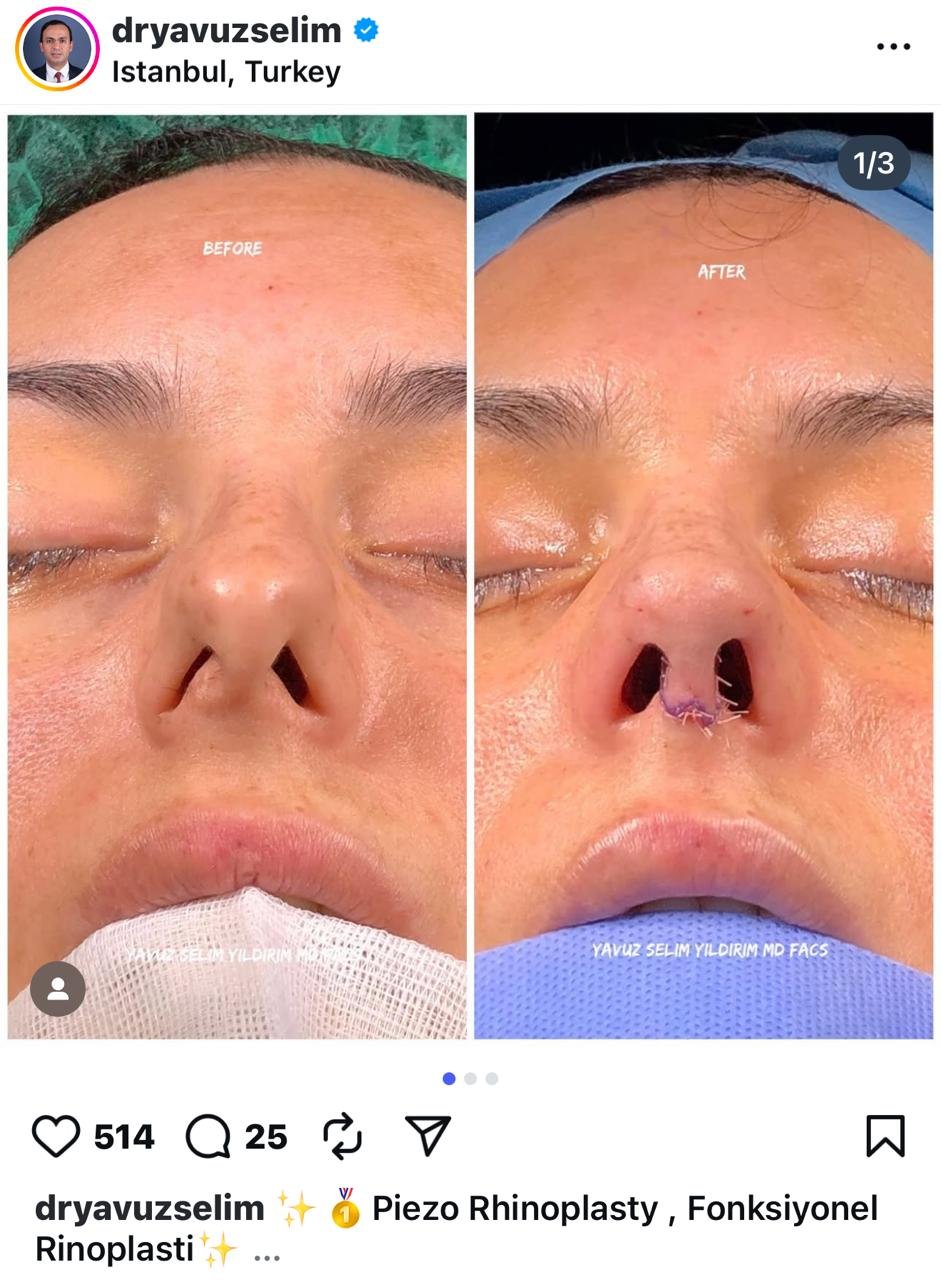 Before and after result by Dr. Yavuz Selim Yıldırım