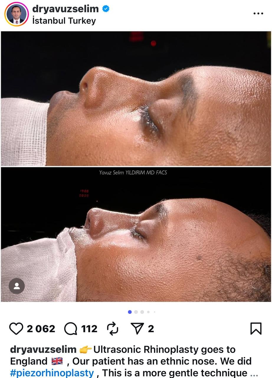 Before and after result by Dr. Yavuz Selim Yıldırım