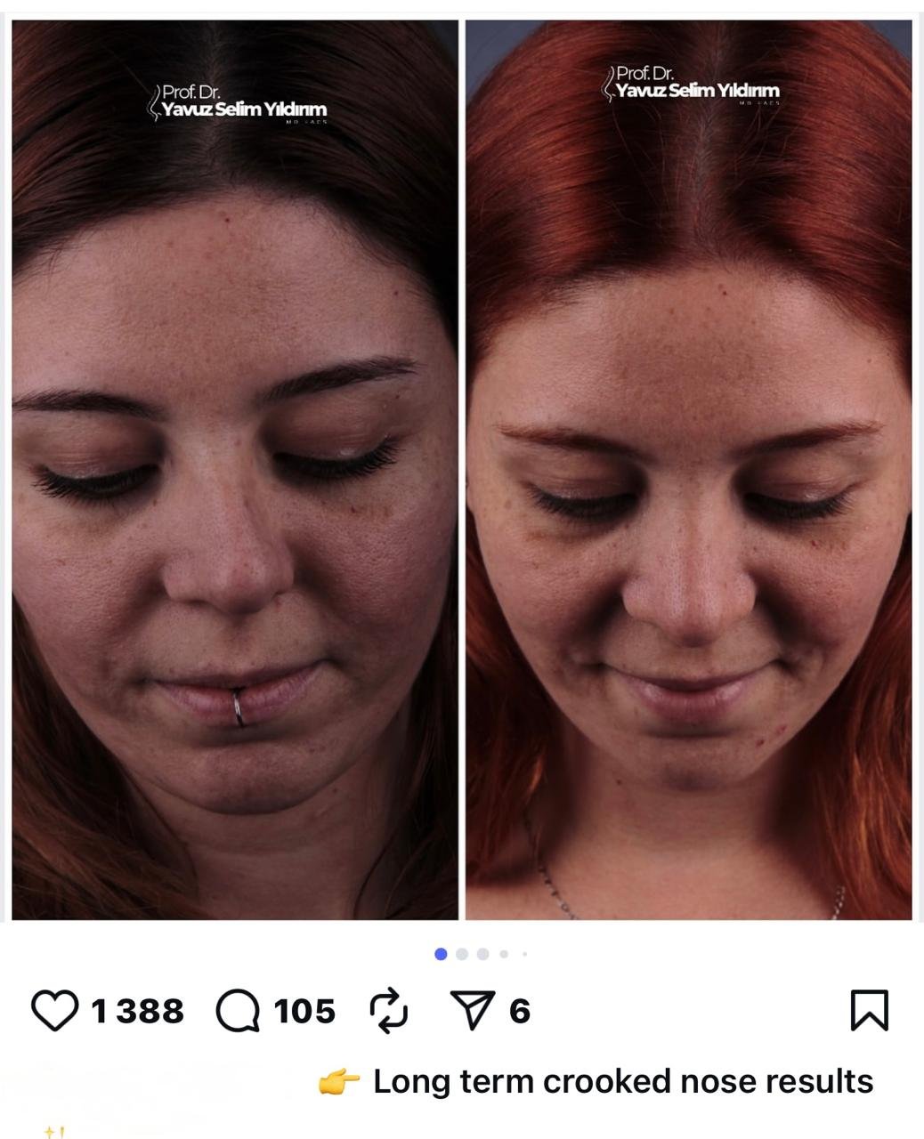 Before and after result by Dr. Yavuz Selim Yıldırım