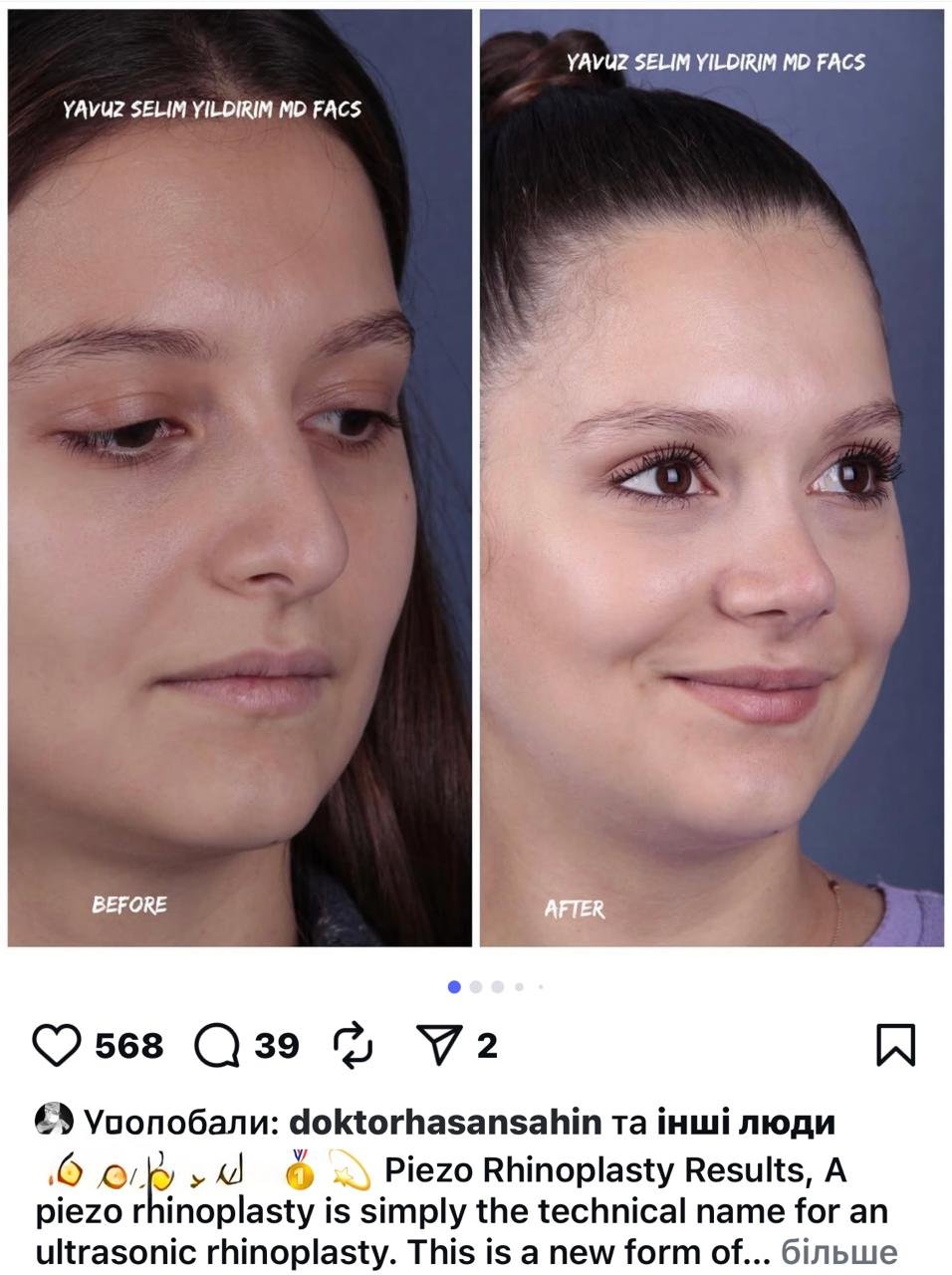 Before and after result by Dr. Yavuz Selim Yıldırım