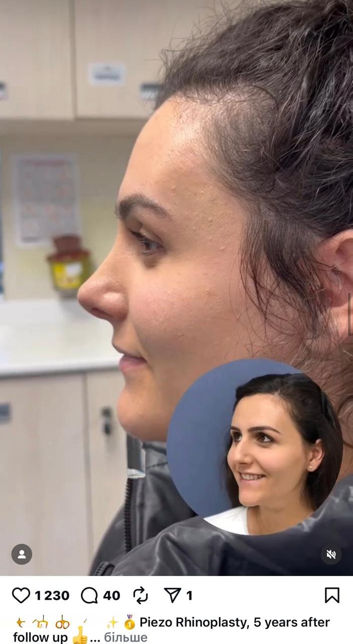 Before and after result by Dr. Yavuz Selim Yıldırım