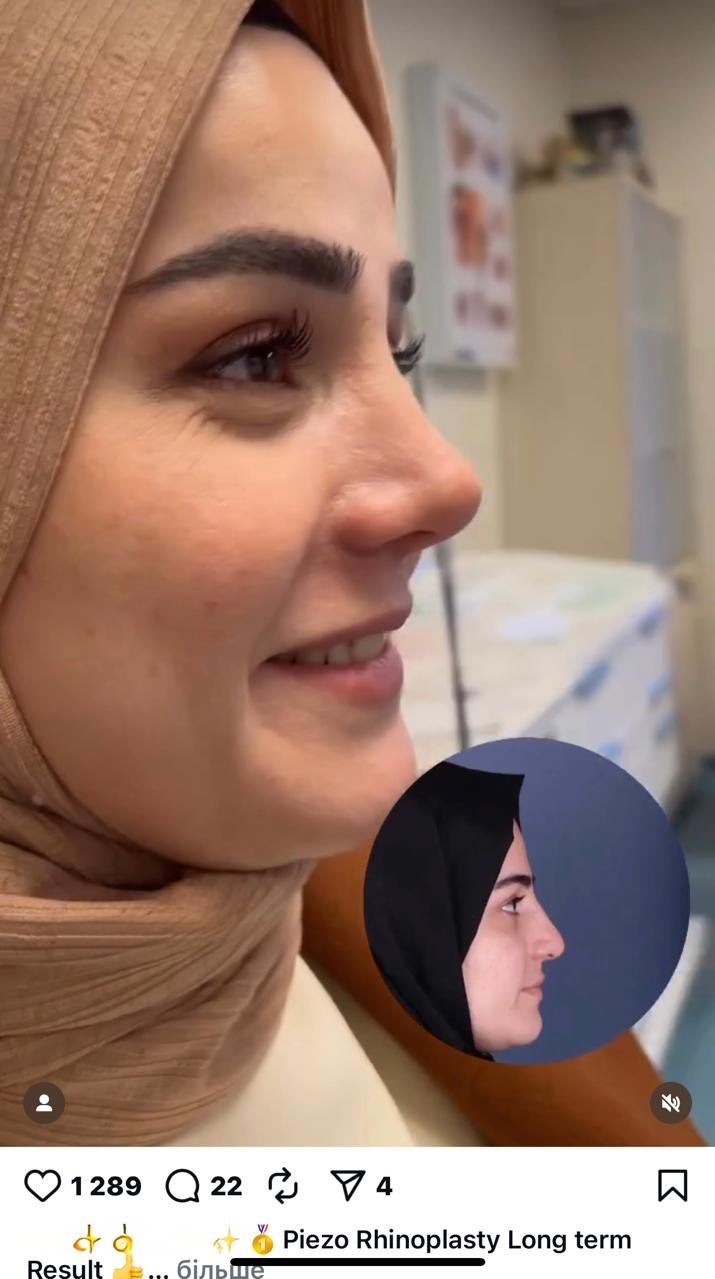Before and after result by Dr. Yavuz Selim Yıldırım