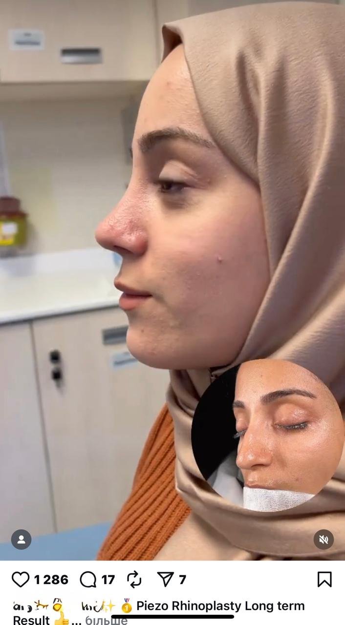 Before and after result by Dr. Yavuz Selim Yıldırım