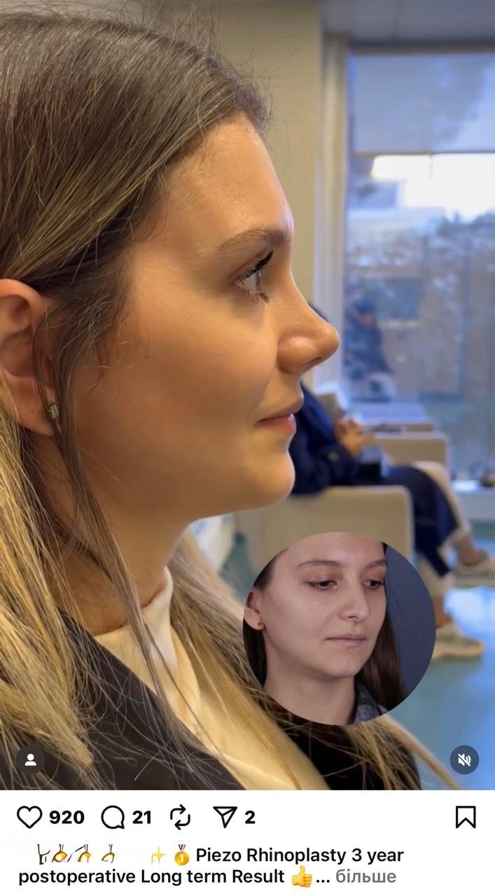 Before and after result by Dr. Yavuz Selim Yıldırım