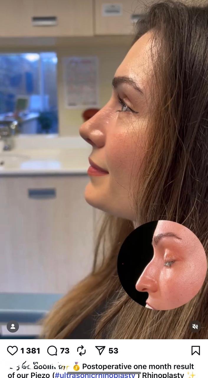 Before and after result by Dr. Yavuz Selim Yıldırım