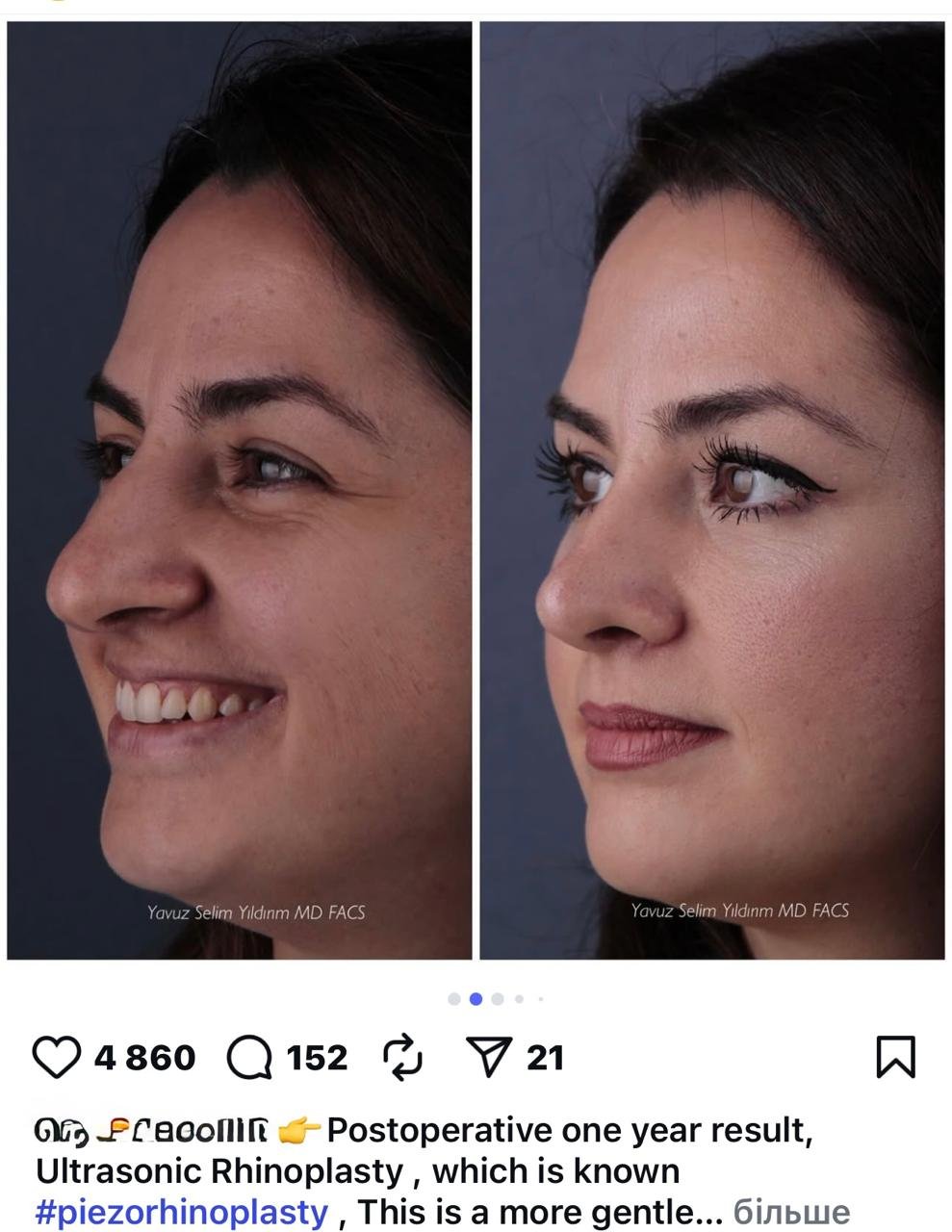 Before and after result by Dr. Yavuz Selim Yıldırım