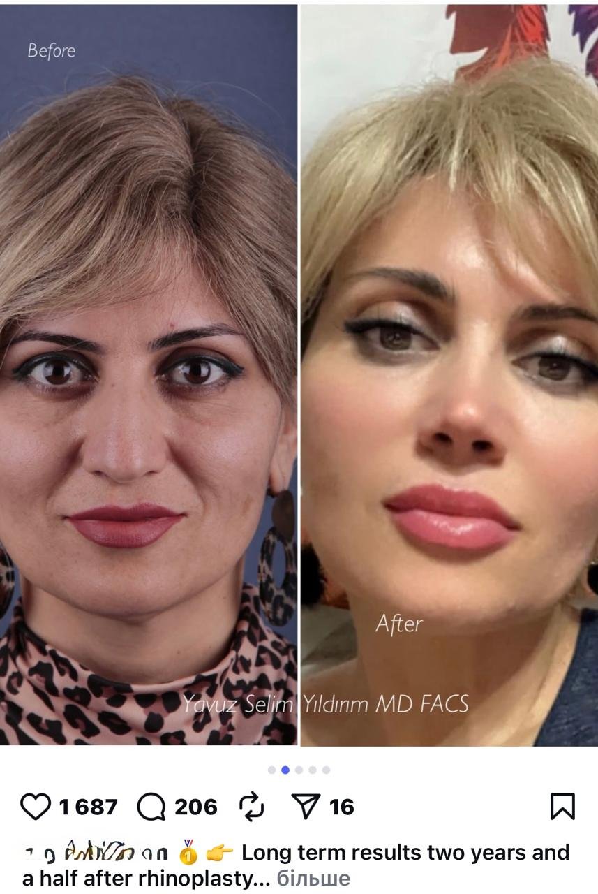 Before and after result by Dr. Yavuz Selim Yıldırım