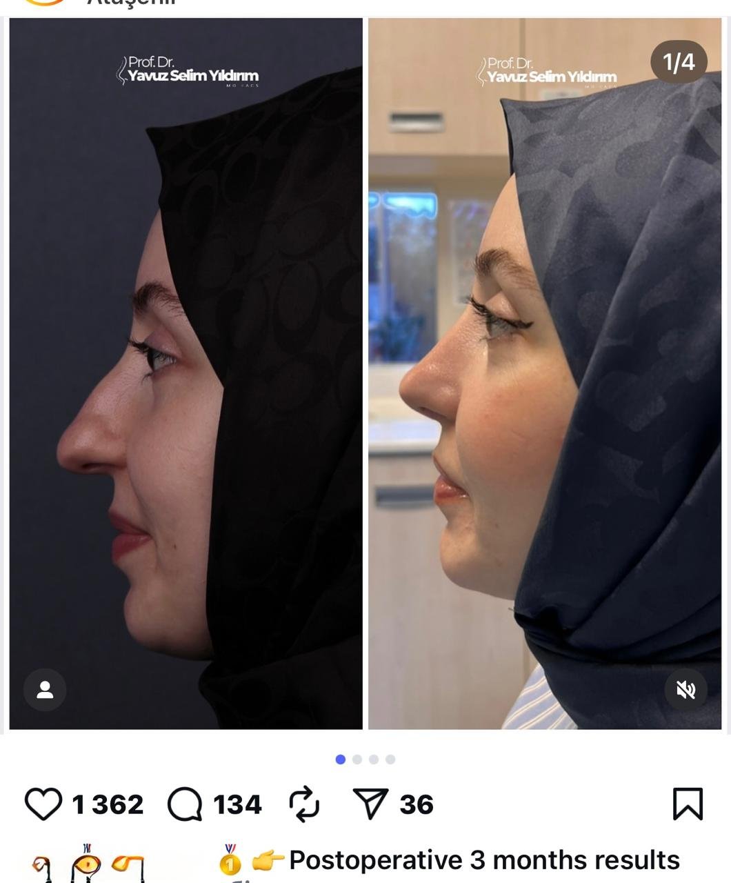 Before and after result by Dr. Yavuz Selim Yıldırım