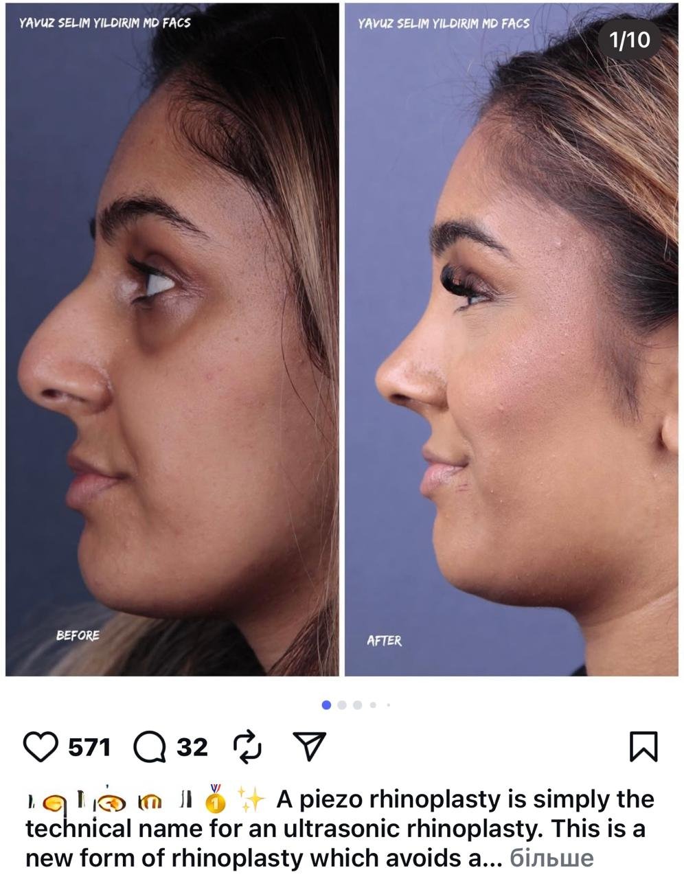 Before and after result by Dr. Yavuz Selim Yıldırım