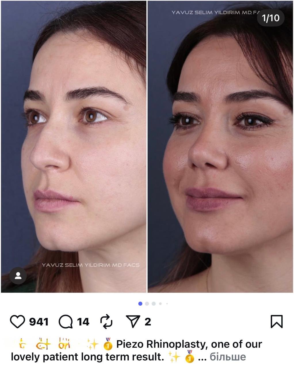 Before and after result by Dr. Yavuz Selim Yıldırım