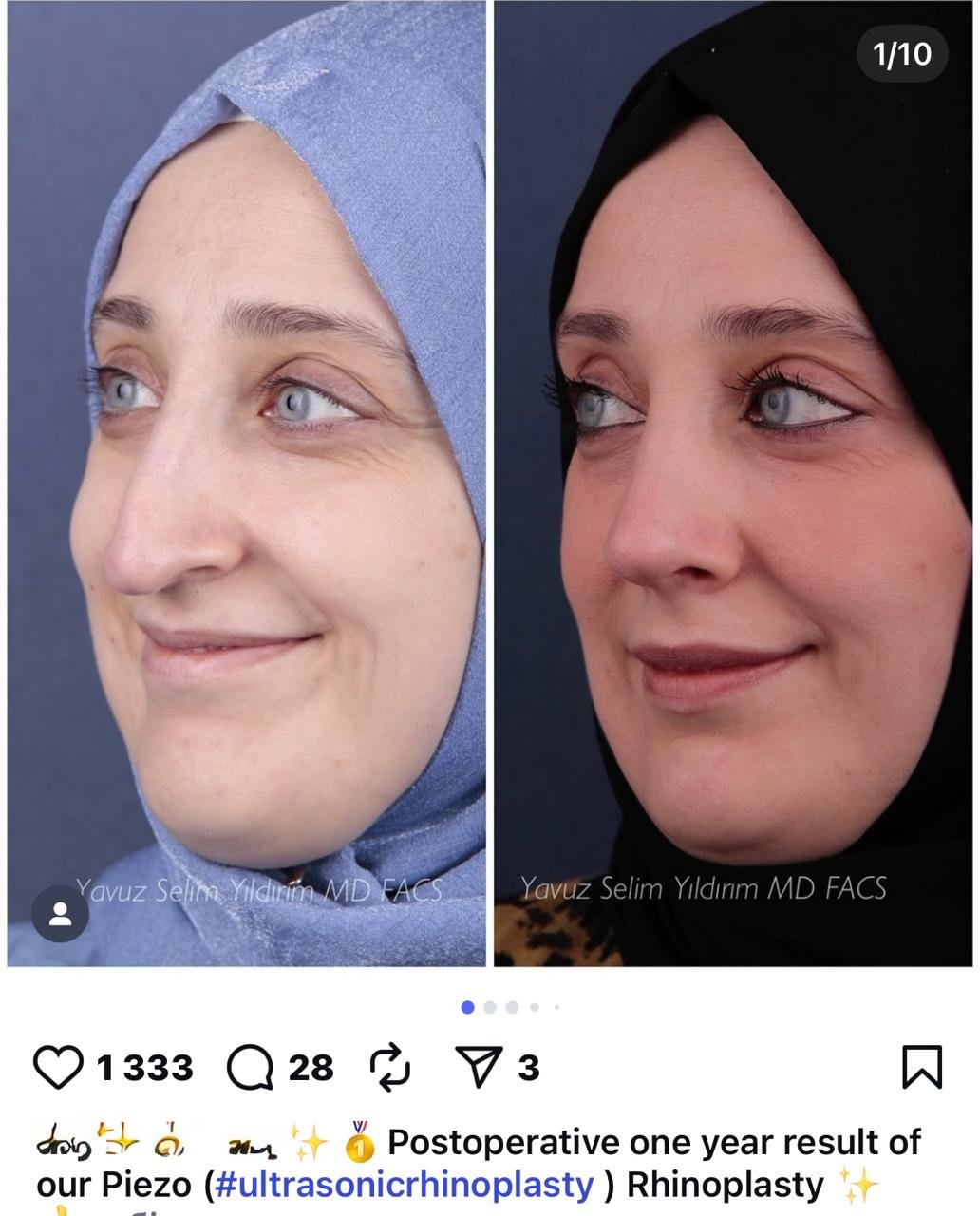Before and after result by Dr. Yavuz Selim Yıldırım