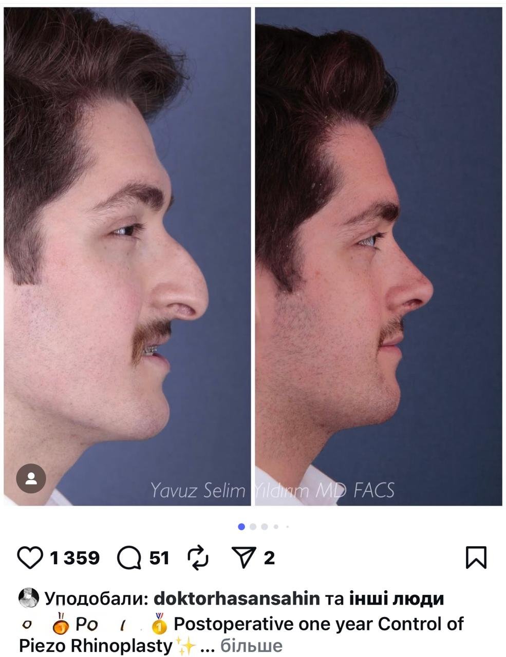 Before and after result by Dr. Yavuz Selim Yıldırım