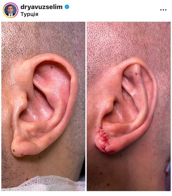 Before and after result by Dr. Yavuz Selim Yıldırım
