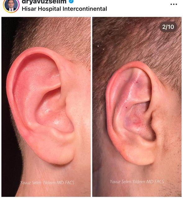 Before and after result by Dr. Yavuz Selim Yıldırım