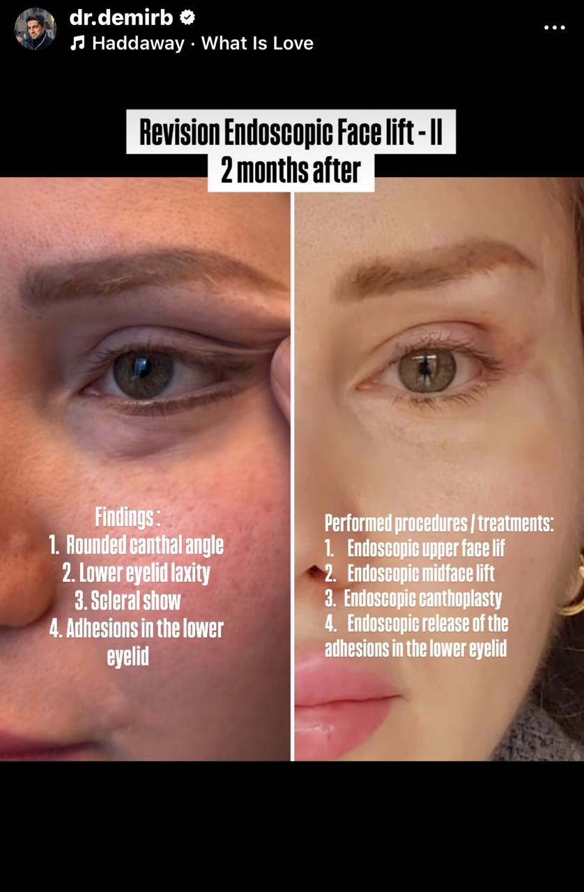 Before and after result by Dr. Burhan Demir