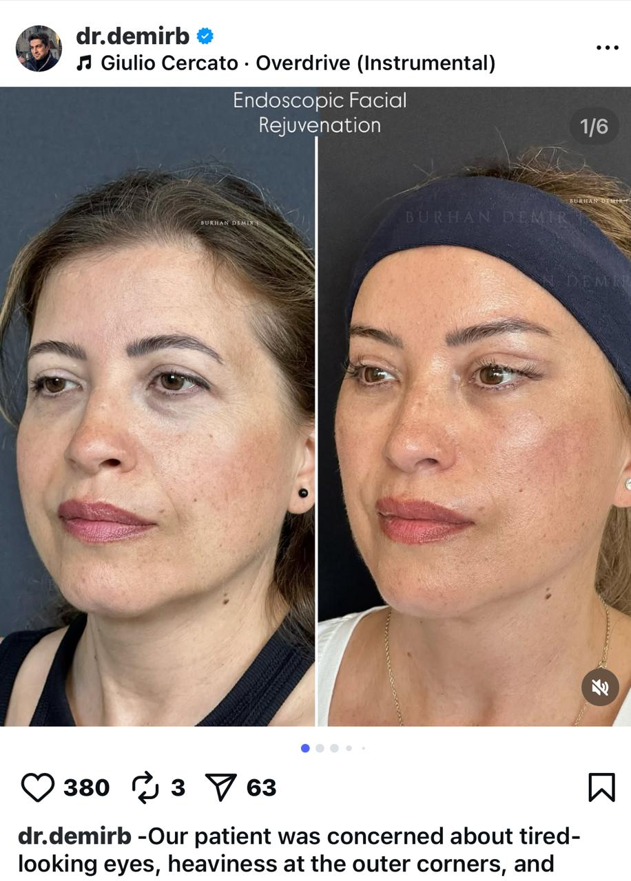 Before and after result by Dr. Burhan Demir