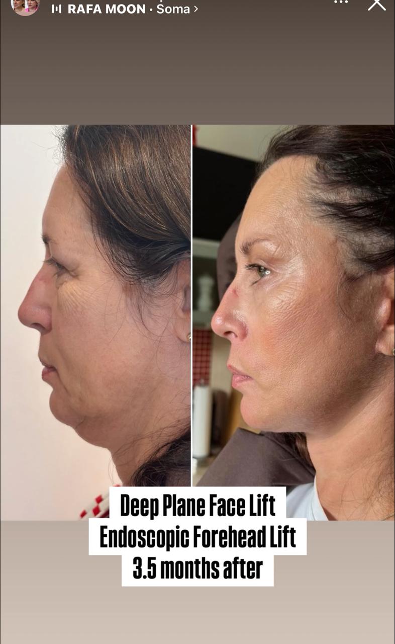 Before and after result by Dr. Burhan Demir