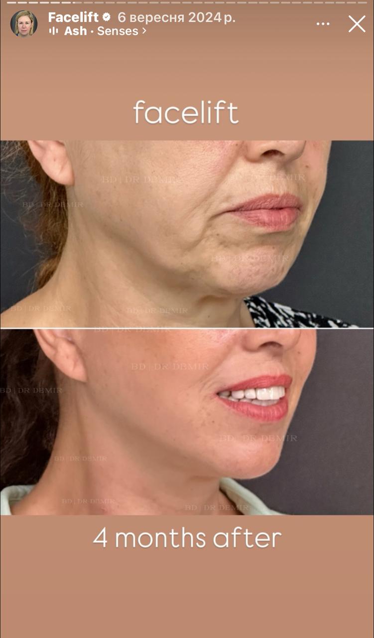 Before and after result by Dr. Burhan Demir