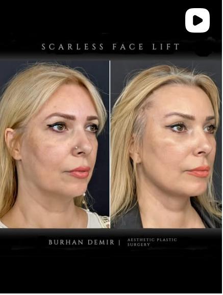 Before and after result by Dr. Burhan Demir