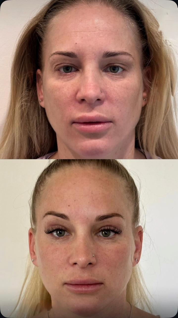 Before and after result by Dr. Burhan Demir