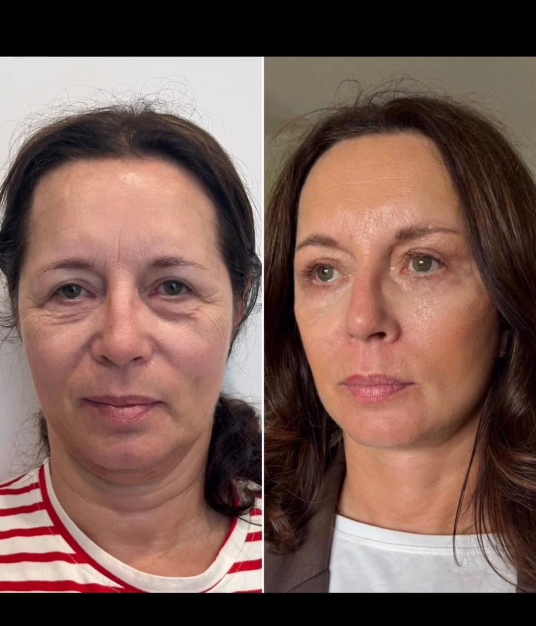 Before and after result by Dr. Burhan Demir