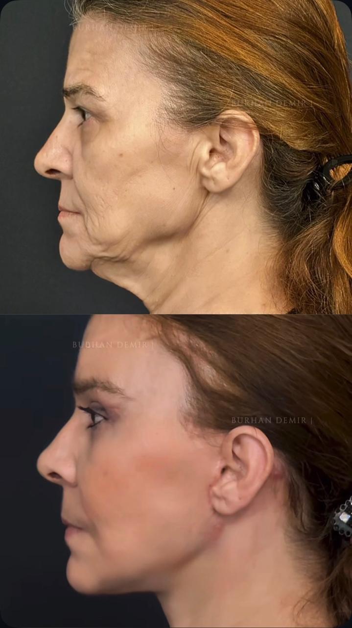 Before and after result by Dr. Burhan Demir