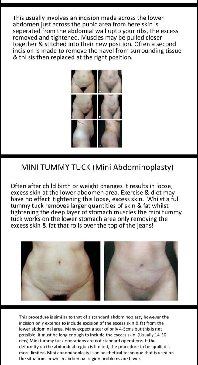 Before and after result by Dr. Çağrı Sade