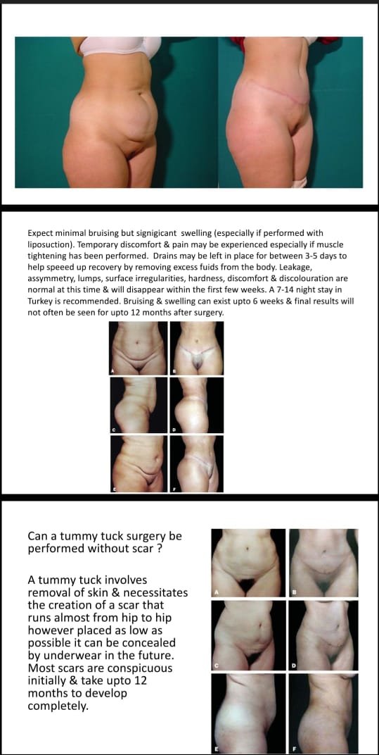 Before and after result by Dr. Çağrı Sade