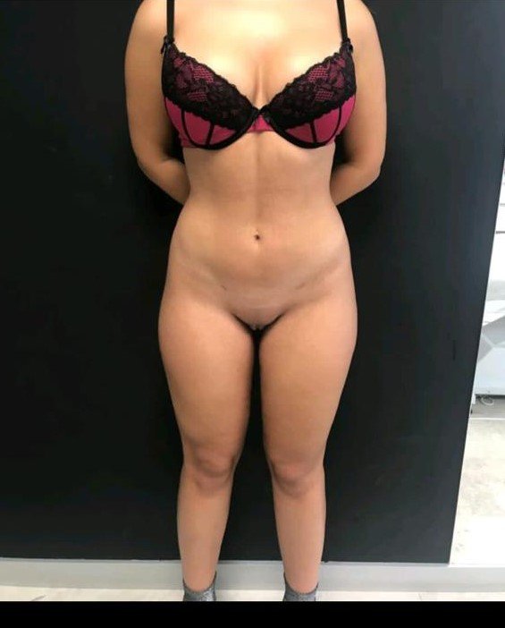 Before and after result by Dr. Çağrı Sade