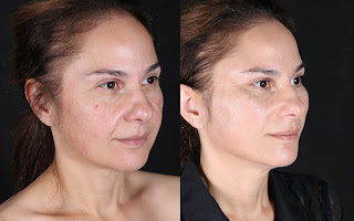 Before and after result by Dr. Cenk Şen