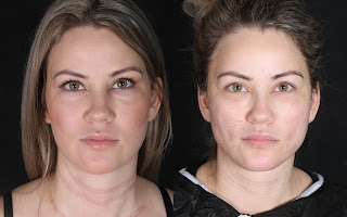 Before and after result by Dr. Cenk Şen