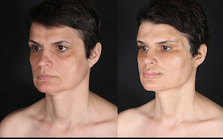 Before and after result by Dr. Cenk Şen