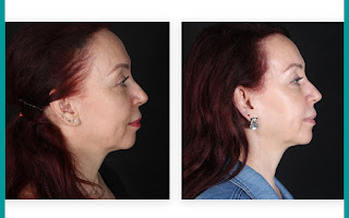 Before and after result by Dr. Cenk Şen
