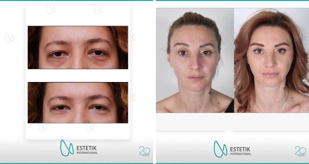 Before and after result by Dr. Cenk Şen