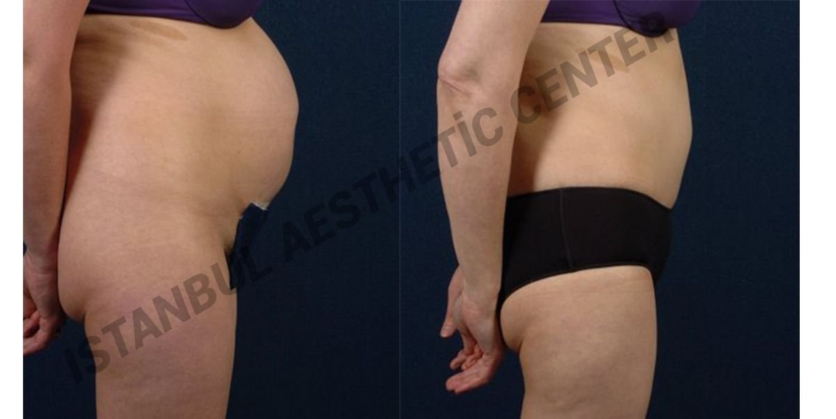 Before and after result by Dr. Ergin Er