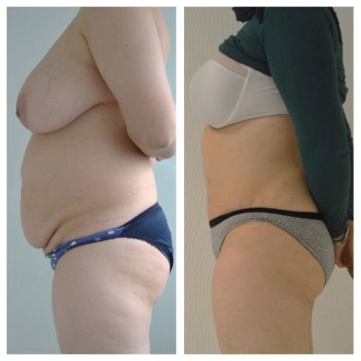 Before and after result by Dr. Ergin Er